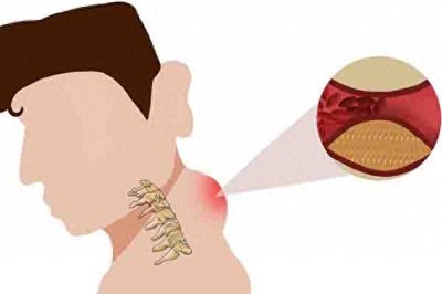 ​为什么脖子后面会长出一个包？是富贵包，还是“夺命包”？